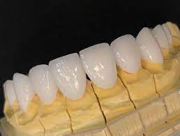 RĂNG SỨ HT SMILE